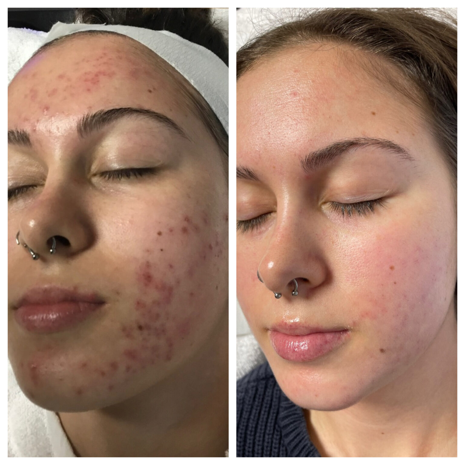 Acne clinic before and after results Kedirose Beauty Kempton Park
