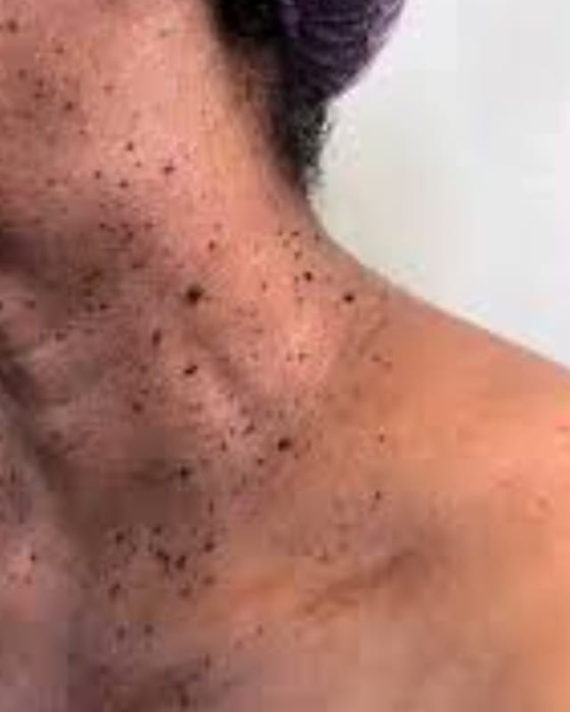 Mole and skin tag removal treatment Kedirose Beauty
