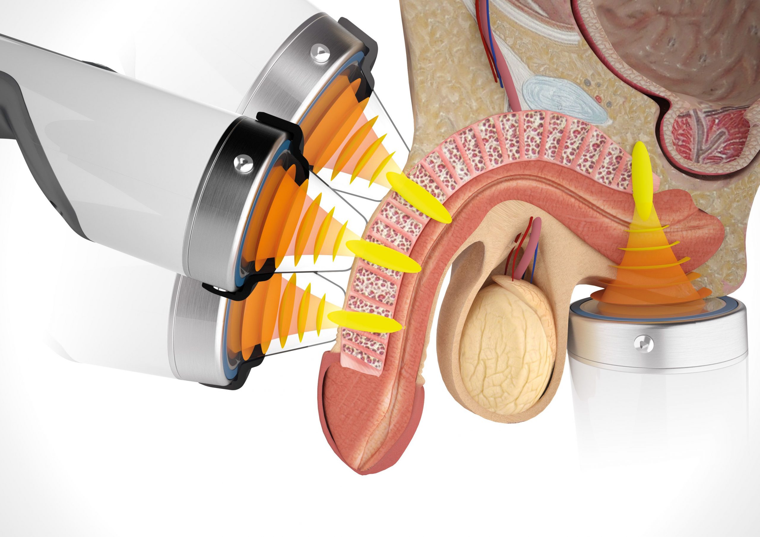 ED Shockwave Therapy