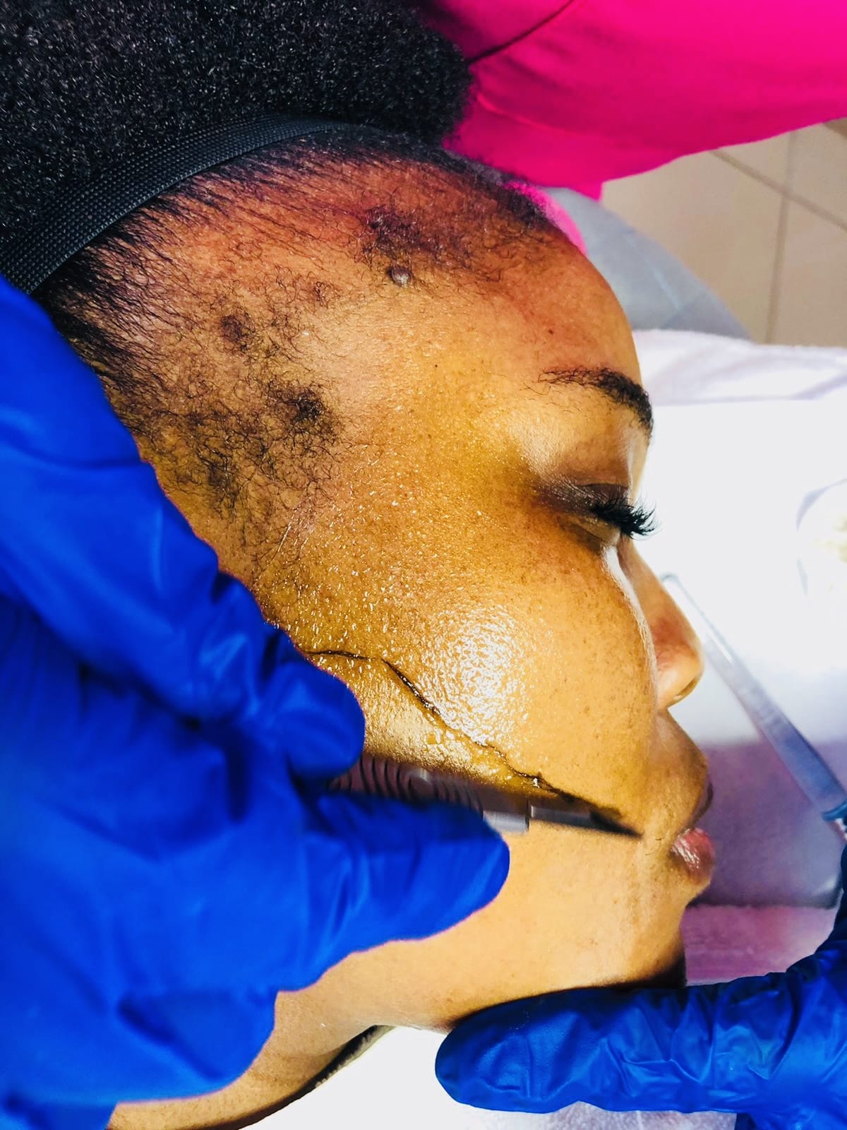 Dermaplaning facial service Kedirose Beauty Clinic South Africa