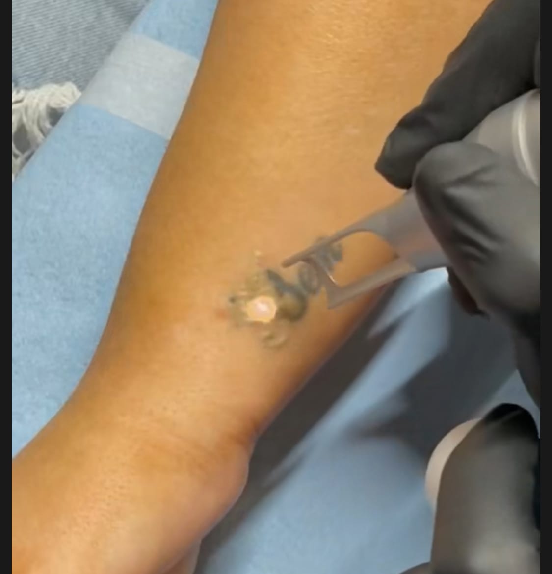 Laser tattoo ink removal treatment Kedirose Beauty Clinic