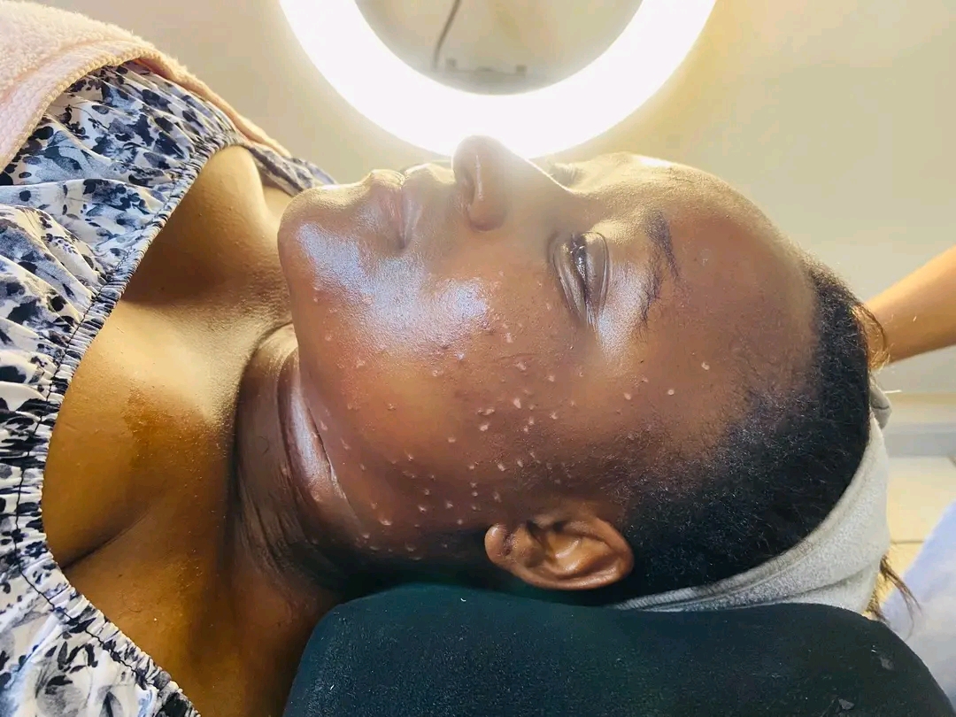 Skin tags removal treatment result Kedirose Beauty Clinic Kempton Park