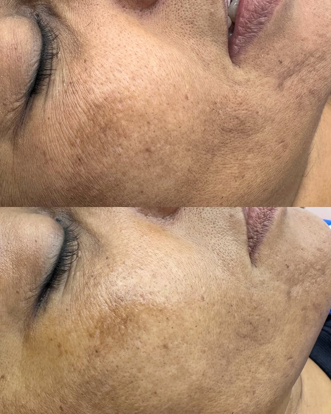 Dermaplanning facial treatment Kedirose Beauty Clinic South Africa