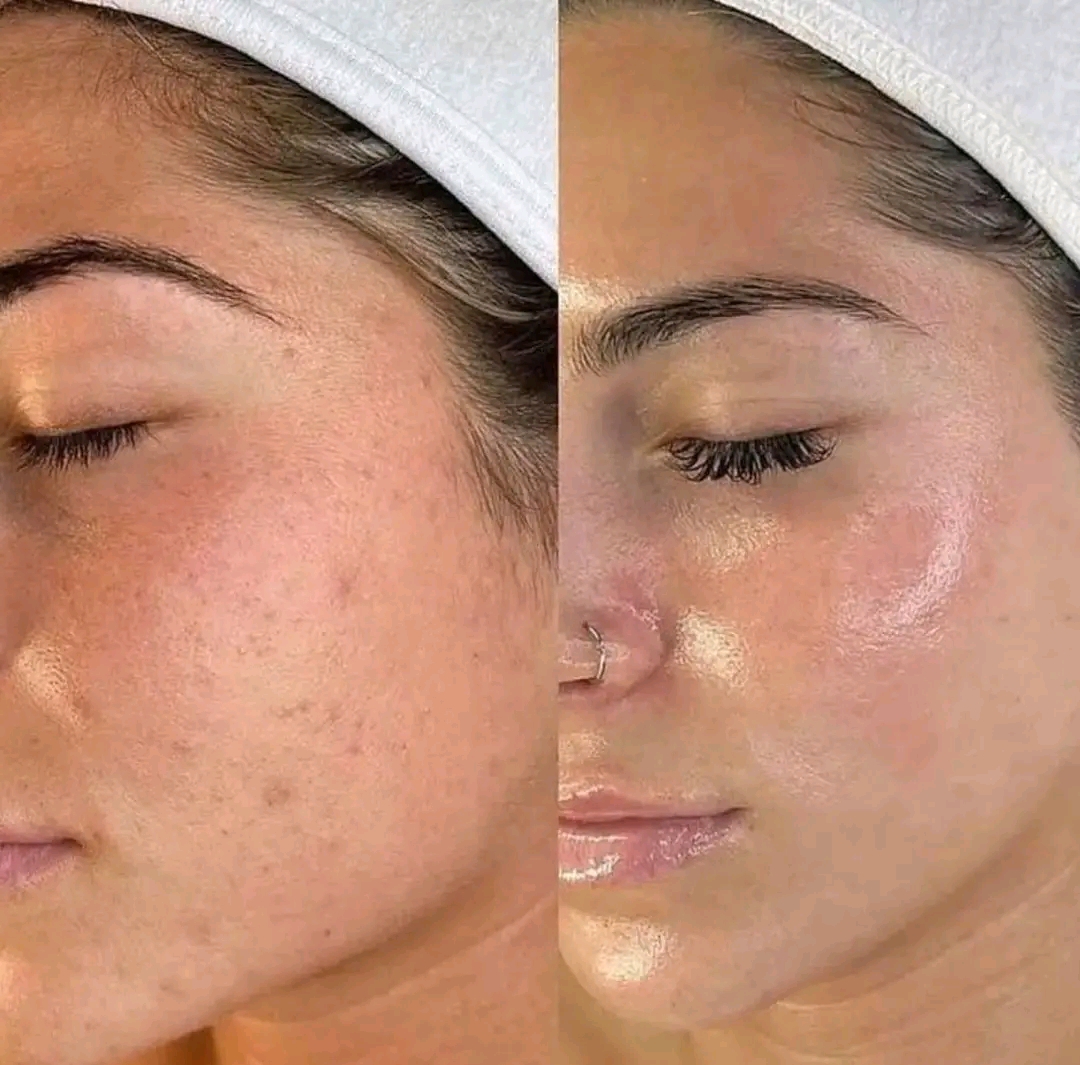 Microneedling skin treatment before and after Kedirose Beauty Kempton Park