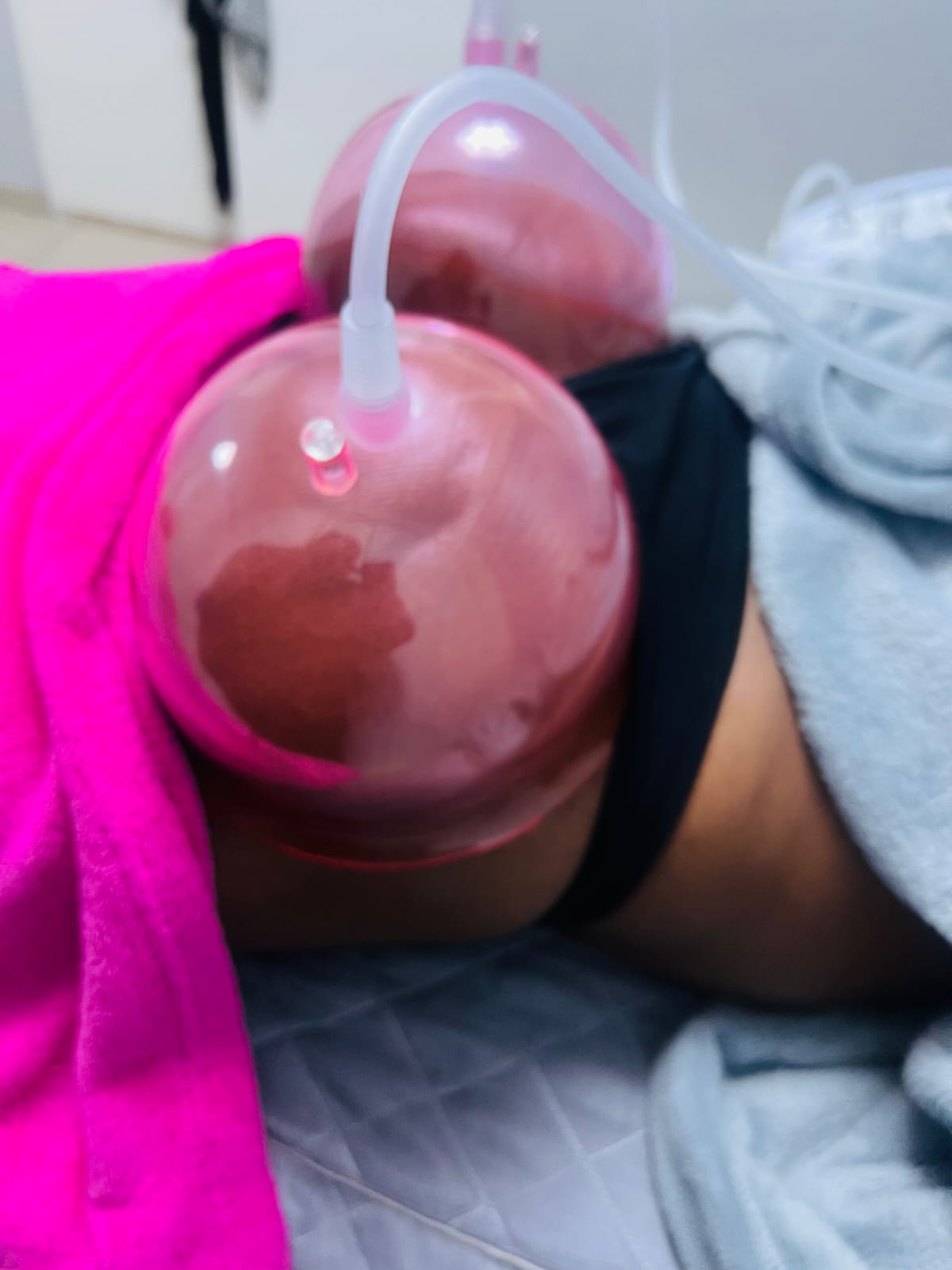 Non-surgical BBL Brazilian butt lift treatment Kedirose Beauty