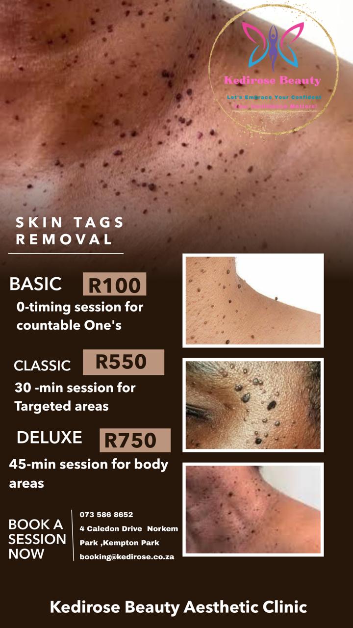 Skin Lesion Removal at Kedirose Beauty & Aesthetic Clinic, Kempton Park