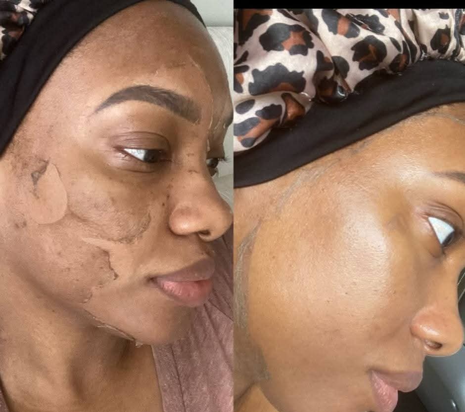 Skin peel before and after results transformation Kedirose Beauty Clinic
